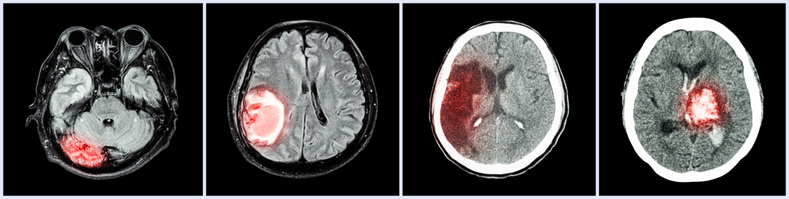 Brain xray